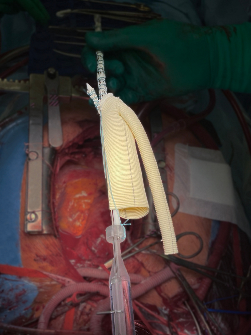 3. Протез аорты, разработанный в НМИЦ им. Мешалкина.jpg